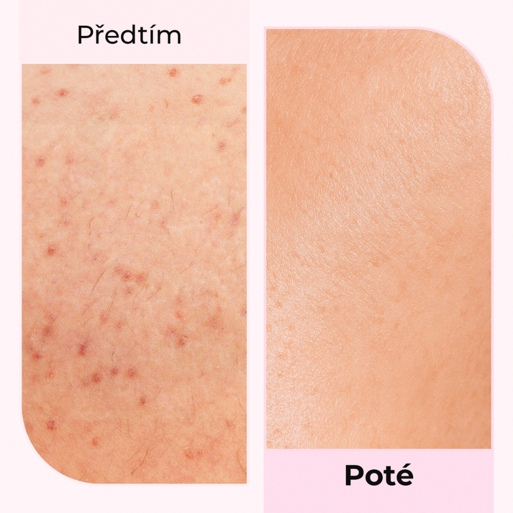 Výsledky před a po použití oleje Silky Balloon od LumiSilk – viditelné zklidnění podrážděné pokožky, redukce pupínků a zarudnutí po holení