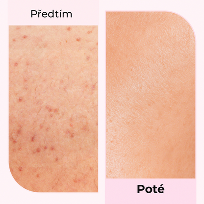 Výsledky před a po použití oleje Silky Balloon od LumiSilk – viditelné zklidnění podrážděné pokožky, redukce pupínků a zarudnutí po holení